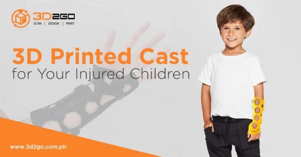 3D Printed Cast for Your Injured Children